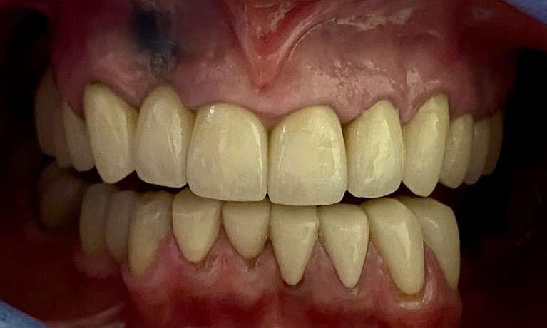 final ceramic crowns