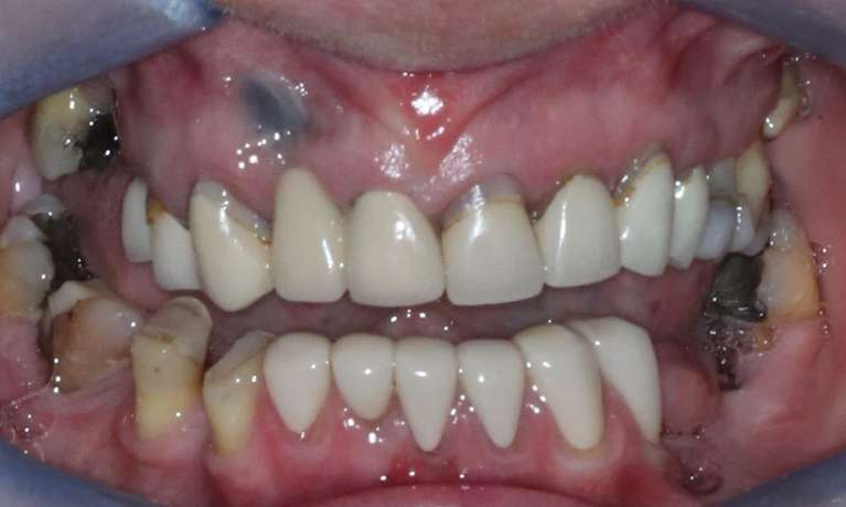 before shot of PFM crowns with exposed margins