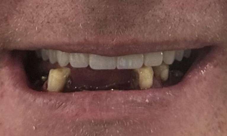 Upper-and-Lower-All-on-4-Before-Image